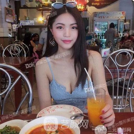 重慶銅雀臺郭世偉假體隆胸案例恢復果圖